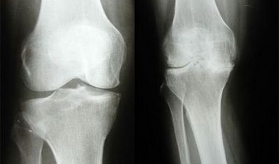 Methods of knee diagnoses