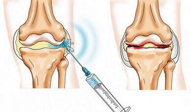 The blockade of the knee joint to arthrosis