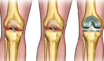 The degree of development of arthosis in the knee joint