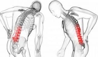 Intervertebral hernia - complication with osteocondrosis