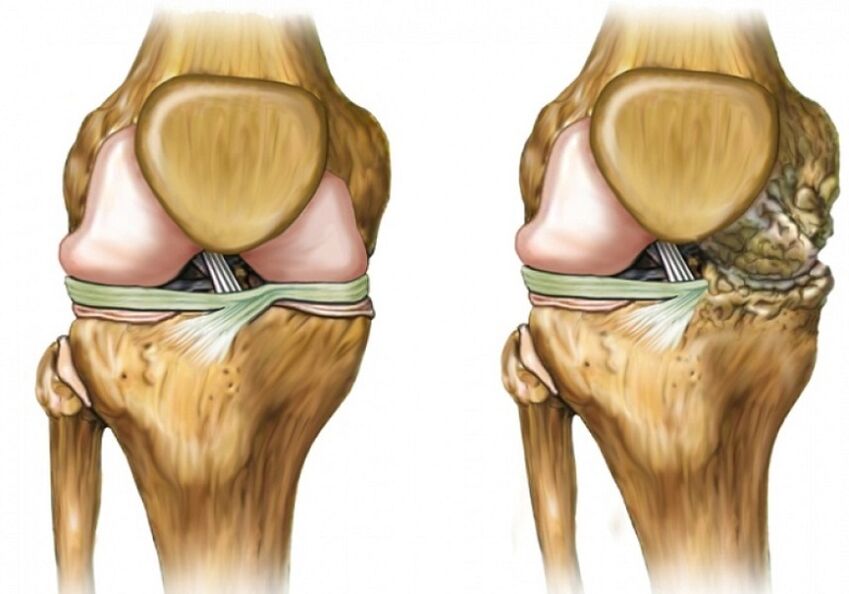 Osteoarthritis of the knee