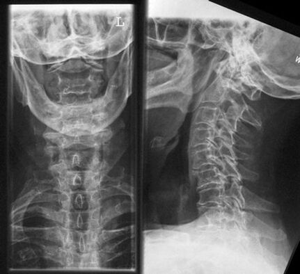 Cervical X -Ray - Method of Diagnosis of Osteocondrosis