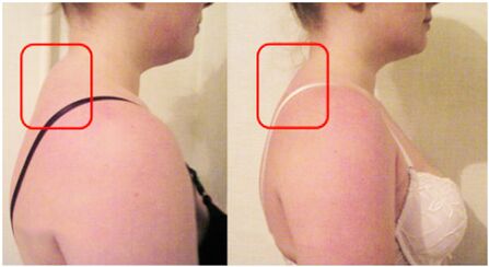 Formation of muscle roll with cervical osteocondrosis