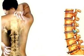 Back pain in different stages of the development of cervical osteocondrosis