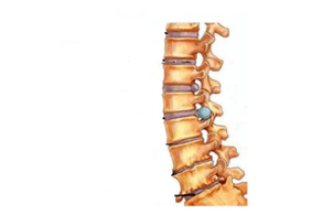 Damage to the spine with cervical osteocondrosis