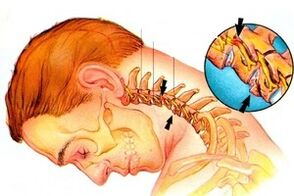Squeezed nerve in the spine with cervical osteocondrosis