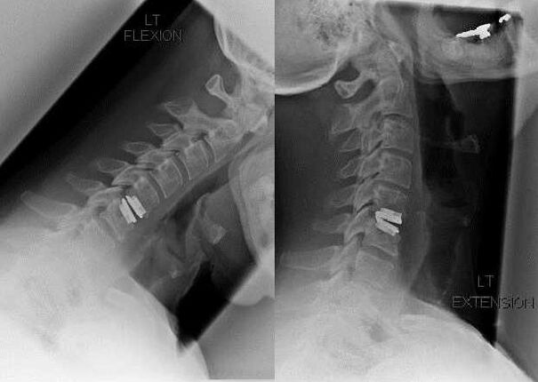 picture of the spine after the operation