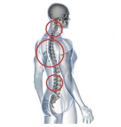 sites of spinal osteochondrosis