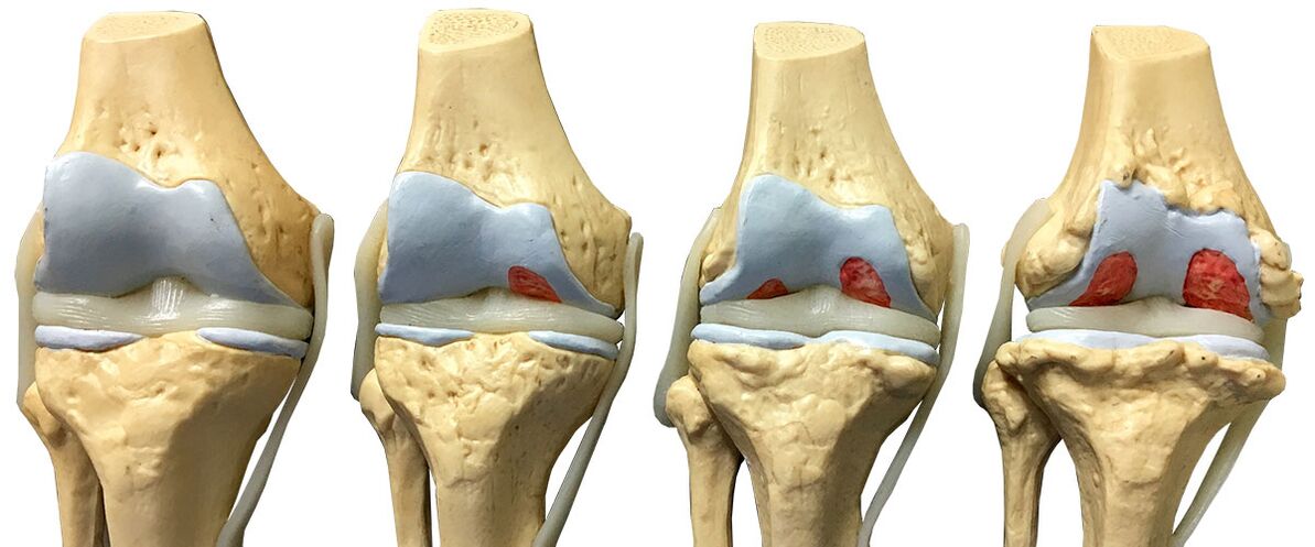 stages of osteoarthritis