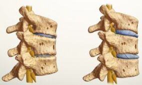 what does osteochondrosis look like
