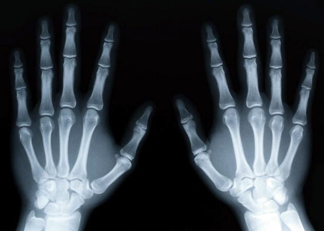 Gout provokes the development of uric acid gout, which can be diagnosed using X-rays