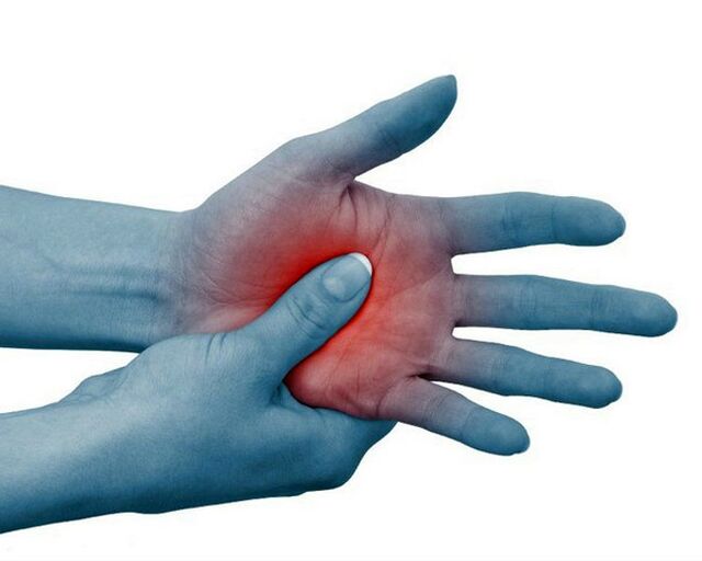 Severe pain in the joints of the fingers, decreasing with exercise, is a typical sign of rheumatoid arthritis.