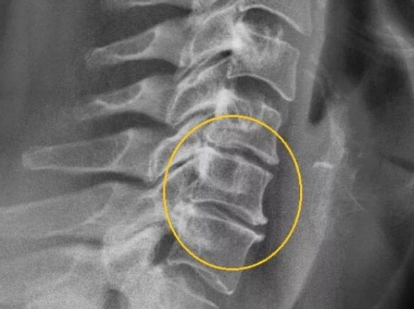 Osteochondrosis of the cervical spine on X-ray